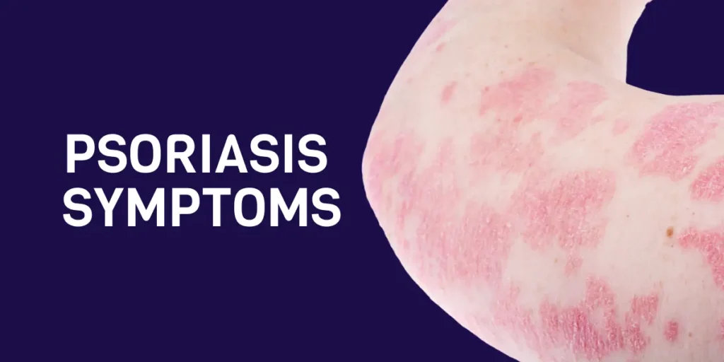 psoriasis symptoms